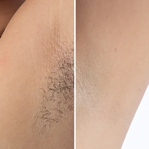 Before and after preview for underarm